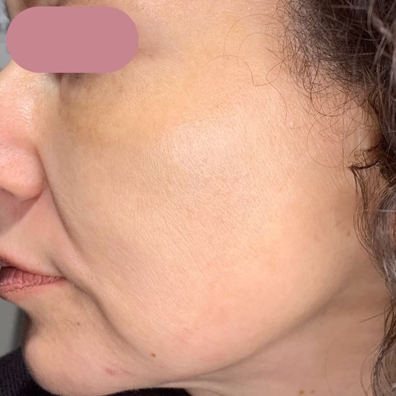After PicoFacial in Bakersfield