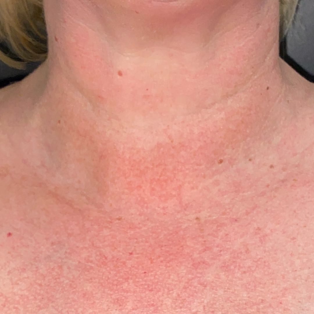 Neck and Chest After