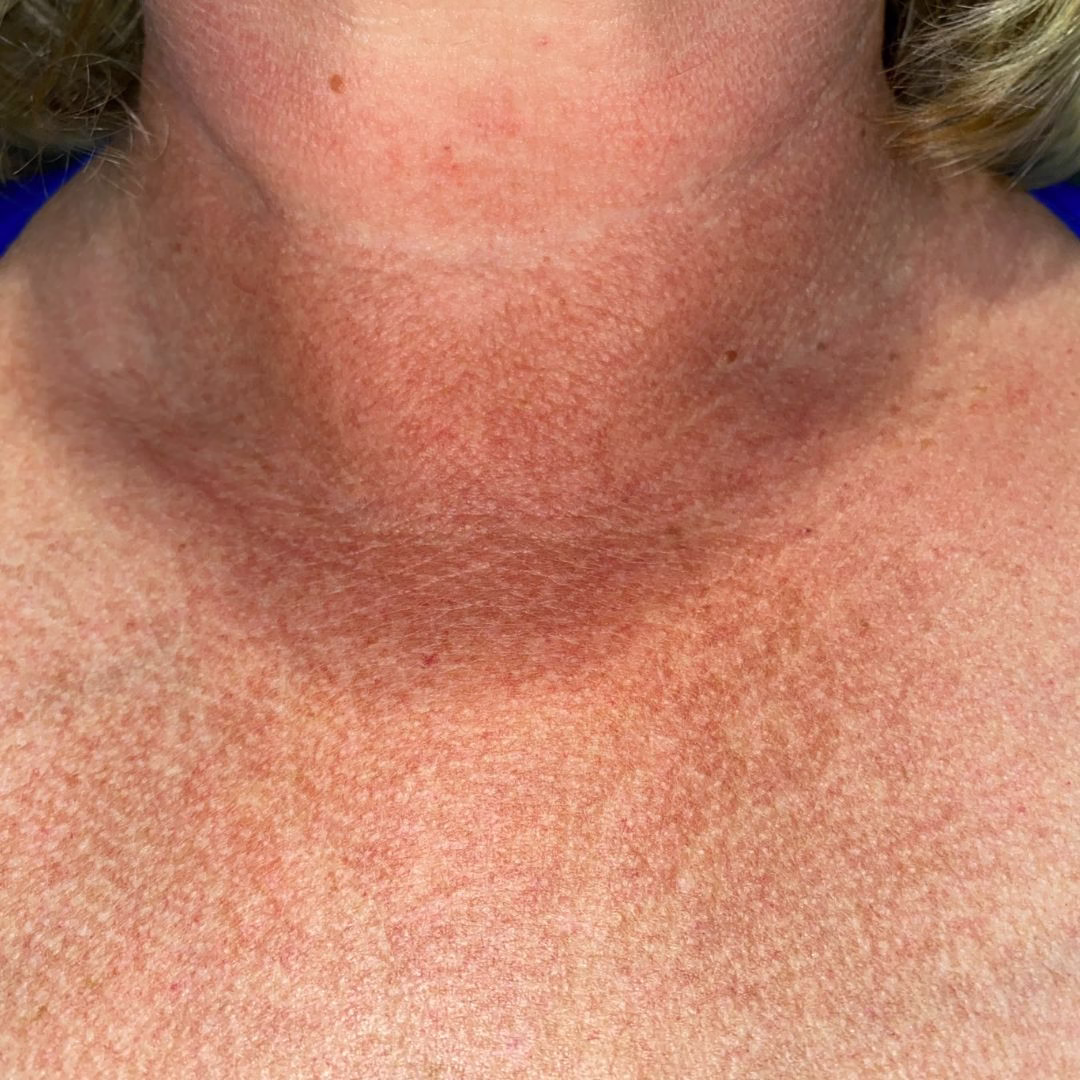 Neck and Chest Before