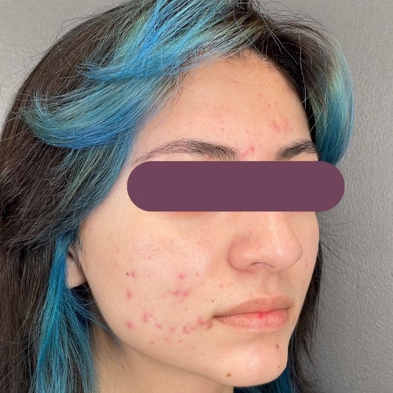 A close up of acne scars