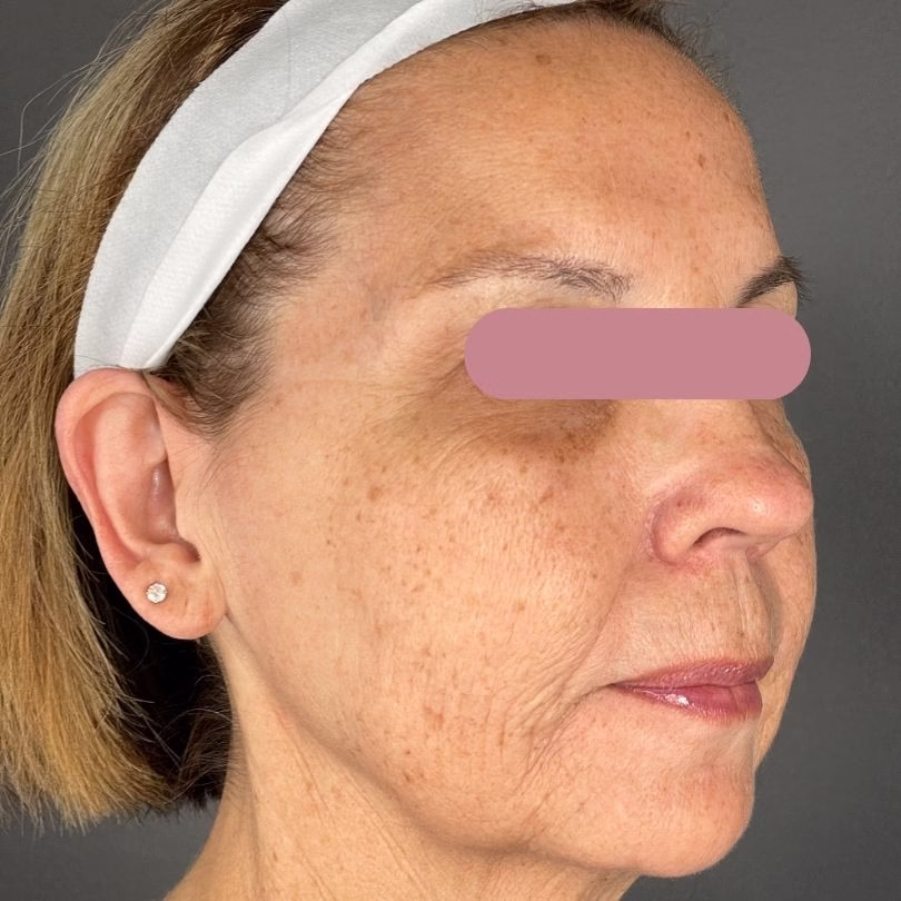 Before MOXI+BBL Treatment in Bakersfield