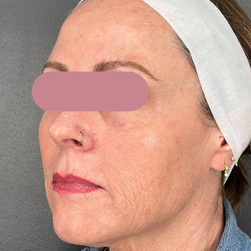 After MOXI+BBL+ProFractional Treatment in Bakersfield