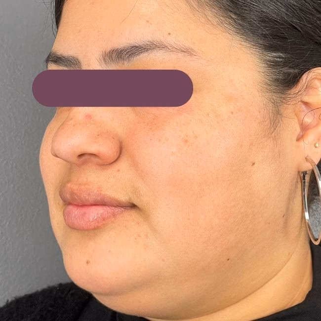 Before Microneedling in Bakersfield at Empire Aesthetic Center