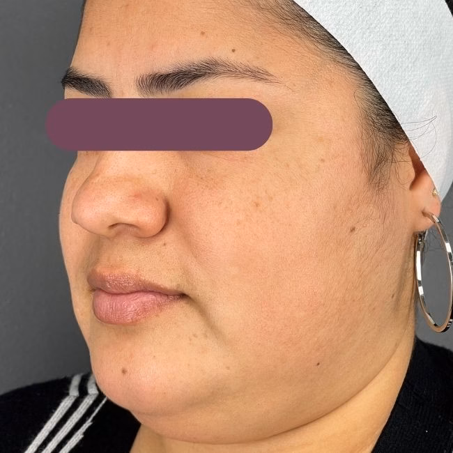 Before Microneedling in Bakersfield at Empire Aesthetic Center